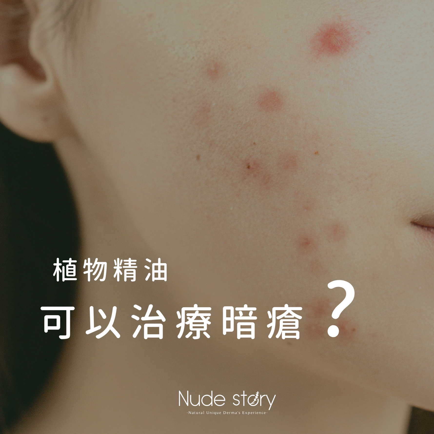 植物精油可治療暗瘡嗎?