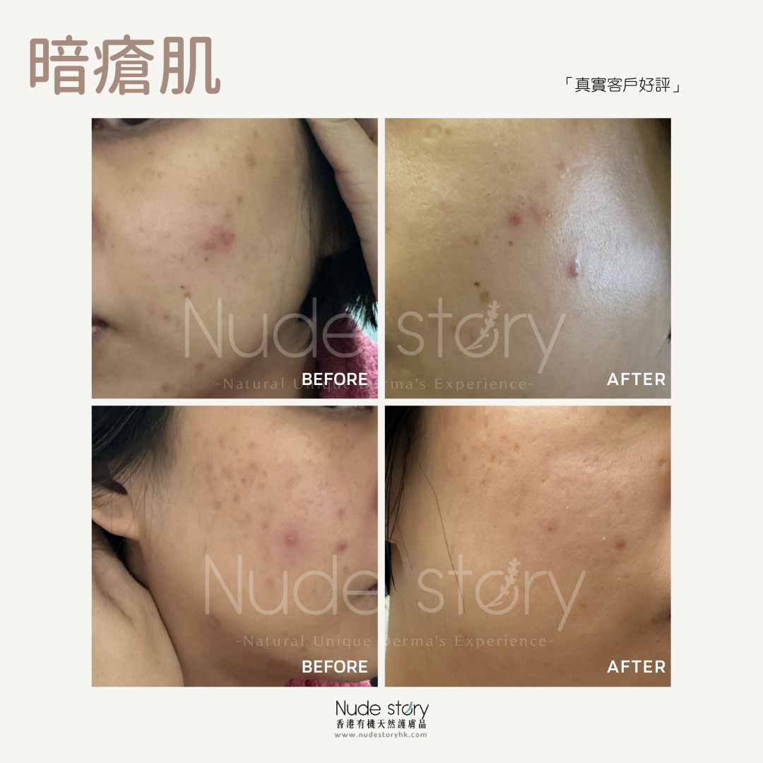 暗瘡|暗瘡印