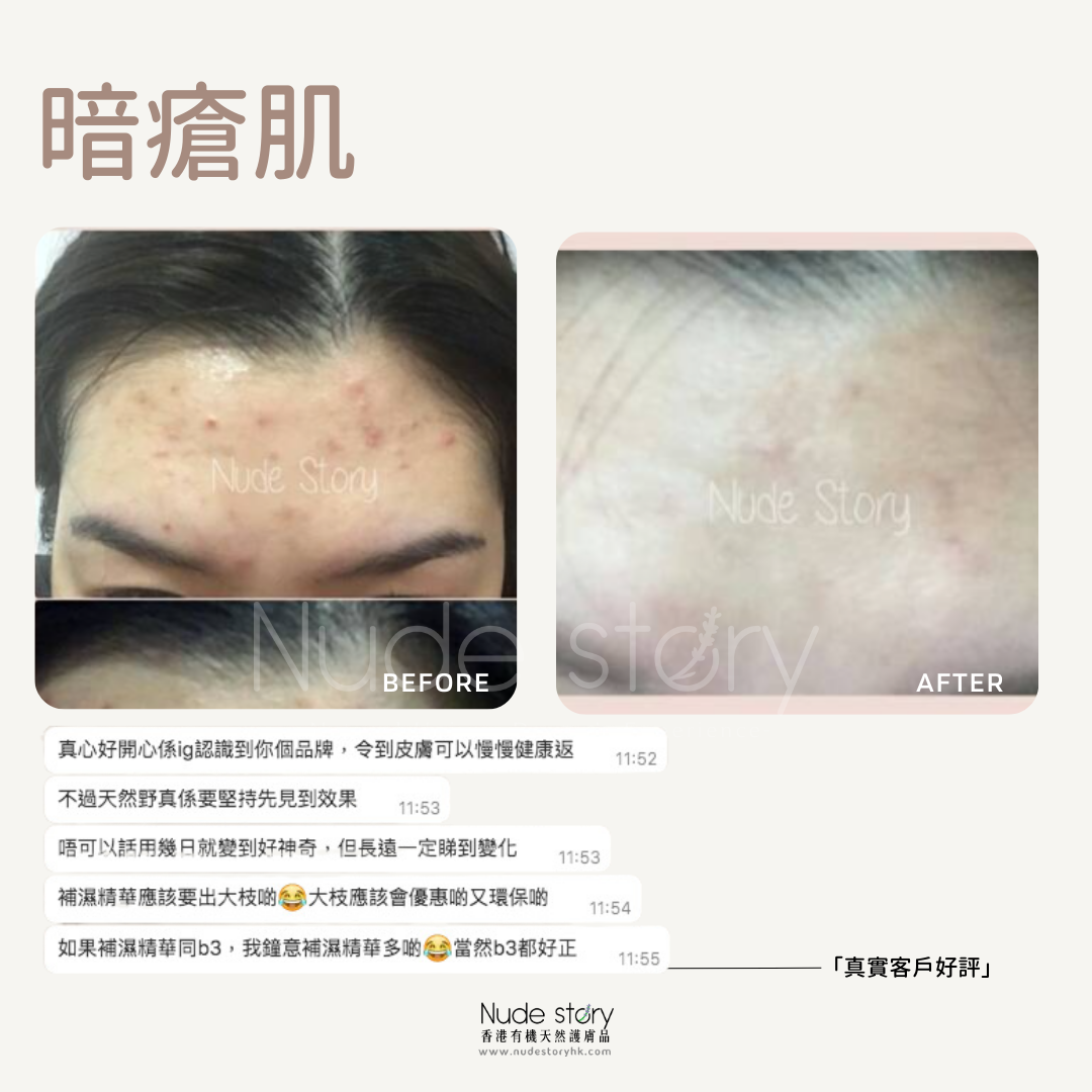 暗瘡|暗瘡印