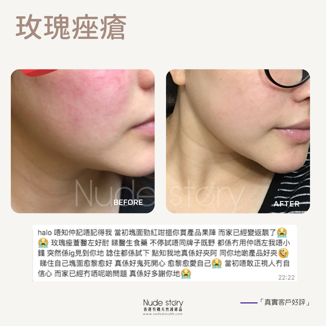 玫瑰痤瘡 rosacea