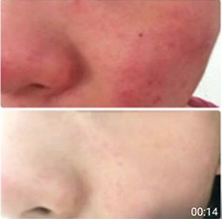 玫瑰痤瘡 rosacea
