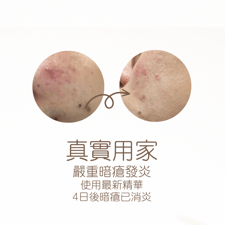 草本抗痘調理精華