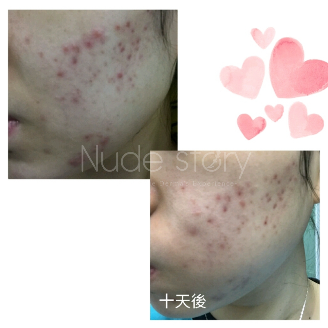 暗瘡｜暗瘡印｜acnes ｜暗瘡肌膚